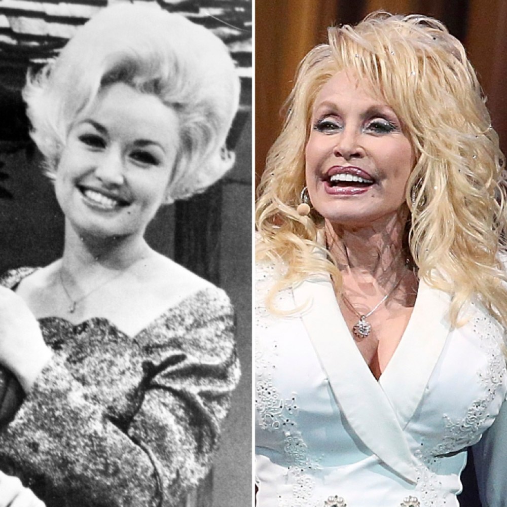 Dolly Parton Plastic Surgery: What Has She Gotten Done?