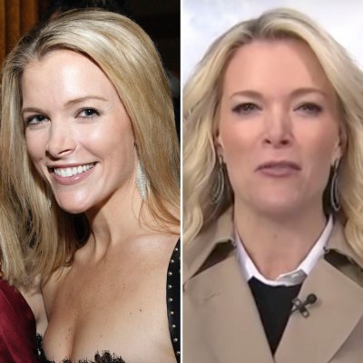 megyn kelly plastic surgery getty images