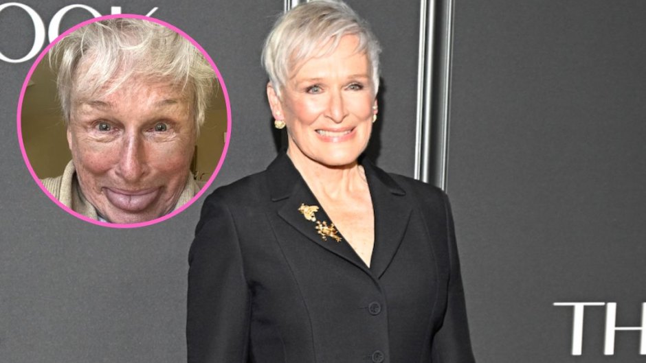 glenn close shows off bruised face after breaking her nose