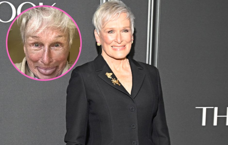glenn close shows off bruised face after breaking her nose